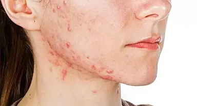 Sivilcelerin kalıcı çözümü nedir?